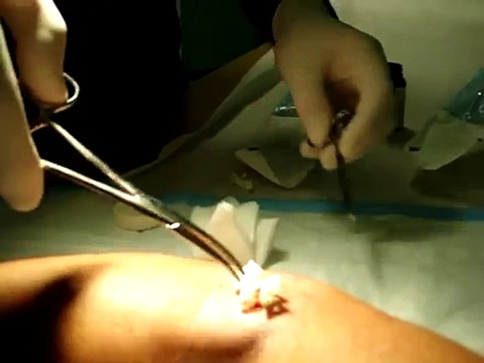 Brown Recluse Bite