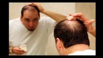 Hair Loss No More-Say Goodbye To Hair Loss