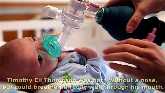 Alabama Baby Born Without a Nose, Mom Says He's Perfect