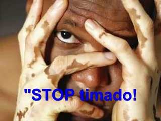 Milagro para el Vitiligo