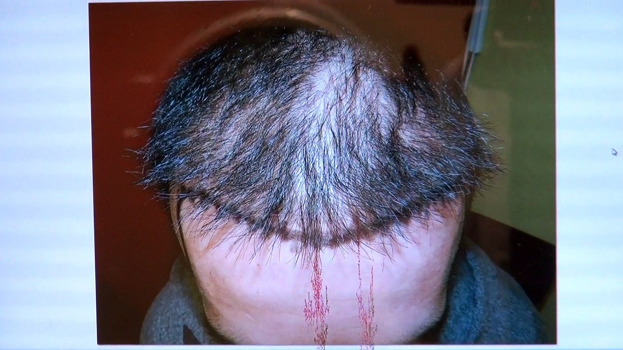 Fantastic Receding Hairline Bald Man Hair Loss Transplant 1 Yr Result Before After Photos Dr. Diep www.mhtaclinic.com