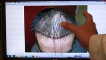 Frontal Hairline Restoration Transplant Treatment 12 Months Follow Up Before After Photos Dr. Diep www.mhtaclinic.com