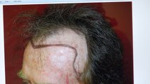 Male Fantastic Frontal Balding Hair Transplantation Result 1 Yr Follow Up Dr. Diep www.mhtaclinic.com