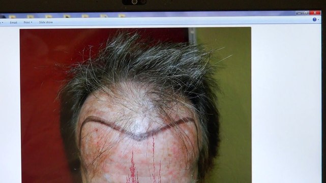 Man Hair Loss Bald Hairline Transplant Restoration Surgery Dr. Diep mhtaclinic.com