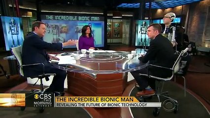 The world's first fully functional bionic man