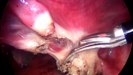 Pasos para realizar una histerectomia por laparoscopia.