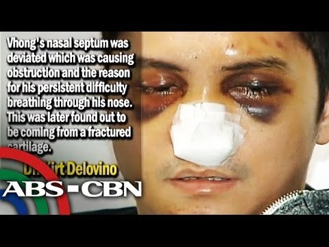 Vhong confirms case with NBI despite his 5 hour surgery