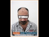 How to design the most natural hairline by FUE Hair Transplant in Pakistan?