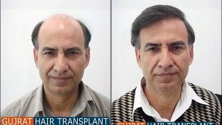 What type of FUE hair transplant available in Pakistan with international standards?