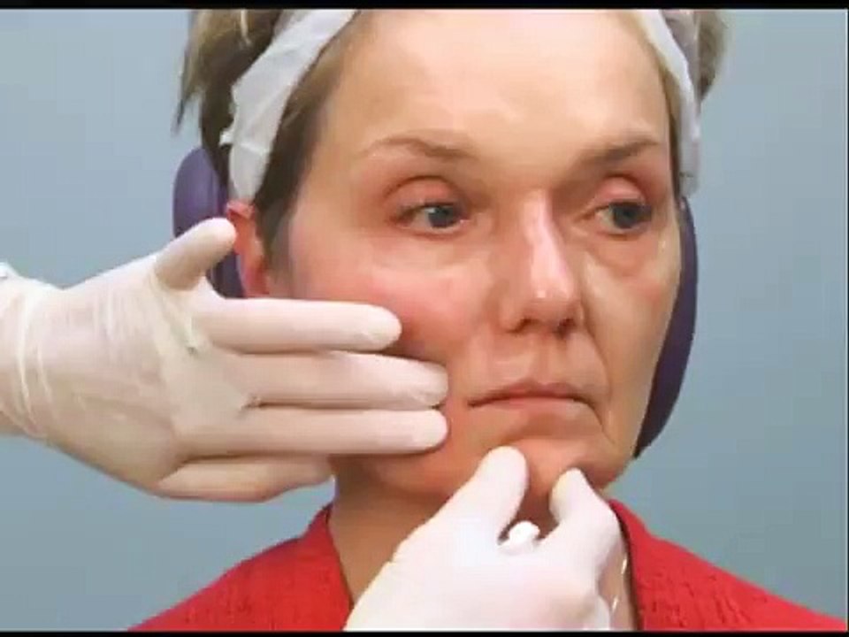 How to Lift Mouth Corners & Marionettes With Dermal Fillers