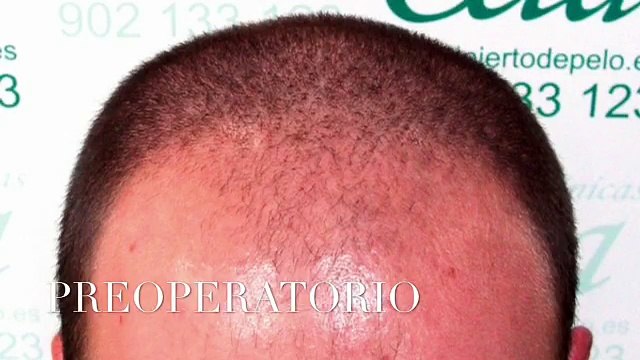 CLINICAS CETA CAPITAL injertodepelo.es