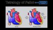 Fetal Echocardiography: Tetralogy of Fallot