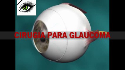 Dra. Vivian Vera - Cirugia Para Glaucoma: CirugIa Filtrante o Trabeculectomia