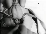 Removal of Tonsils and Adenoids (1930), pt 1 of 2