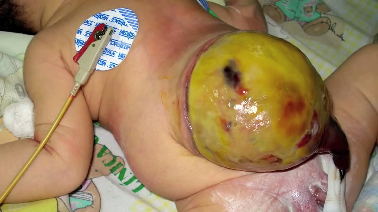 OMPHALOCELE By Dr Abello.mov