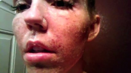 Fractional CO2 Laser Review