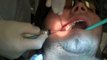 Impacted Wisdom teeth removal by The Gentle Dentist (some surgery shown)
