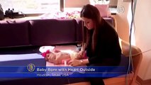 Baby Born with Heart Outside Chest, Ectopia Cordis