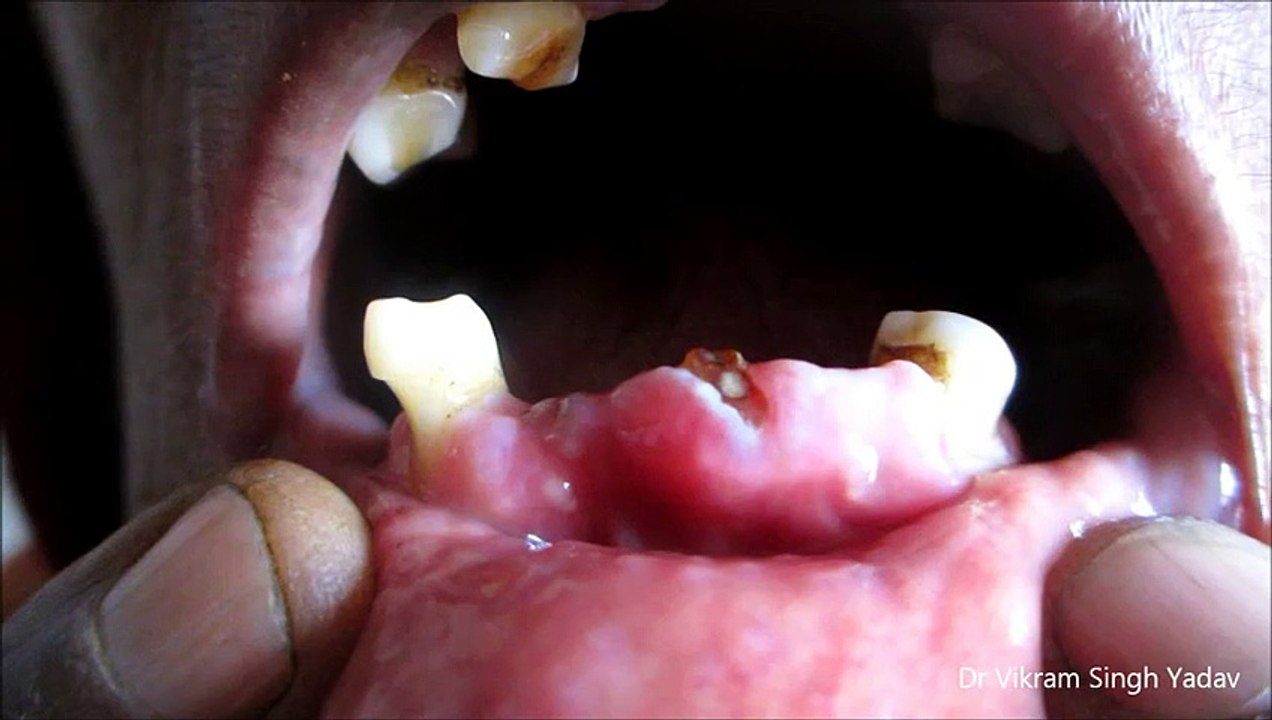 Gingival Recession