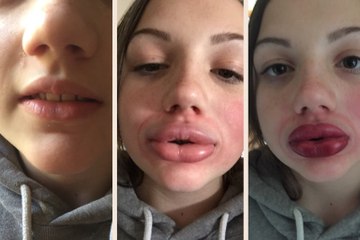 Kylie Jenner Lip Challenge Fail Compilation #kyliejennerlipchallenge