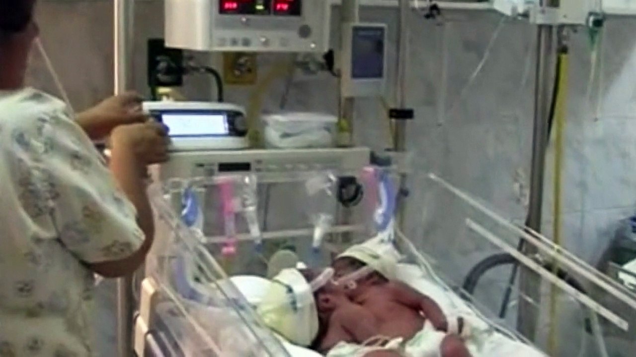 Conjoined twins to be separated