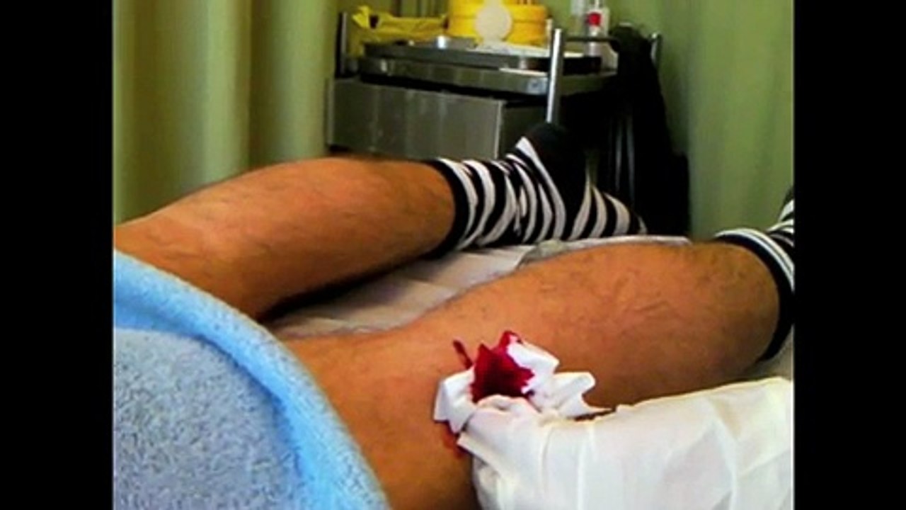 Prt2 Chinese Medicine Blood Letting Treatment, Back Pain