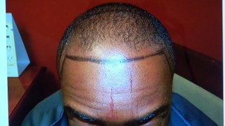 African American Bald Hairline Restoration Surgery Before After Photos 12 Months Result Dr. Diep www.mhtaclinic.com
