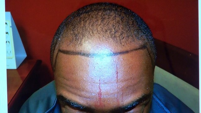 African American Bald Hairline Restoration Surgery Before After Photos 12 Months Result Dr. Diep mhtaclinic.com