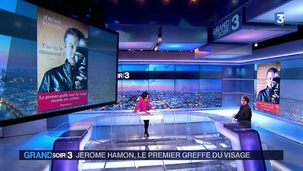 Le premier homme greffé du visage témoigne