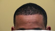 African American Hairline Transplantation Surgery Result Hair Loss Restoration Dr. Diep www.mhtaclinic.com