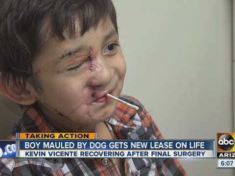 Arizona boy once mauled by pit bull completes final surgery