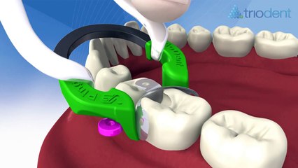 Class II composite restoration using V3 Sectional Matrix System - Triodent
