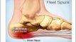 Pain in Heel of Foot | How to Get Rid of Foot Pain Caused by Heel Spurs or Pain in heel of foot