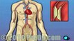 Coronary Artery Bypass (CABG) Surgery