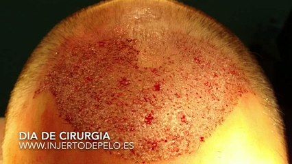 CLINICAS CETA CAPITAL  www.injertodepelo.es