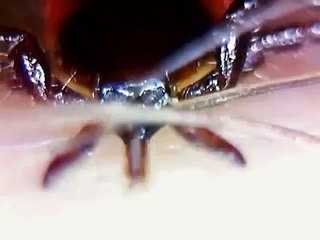 tick biting human leg extreme close up lots of detail