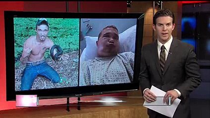 Teen bitten in face by poisonous water moccasin