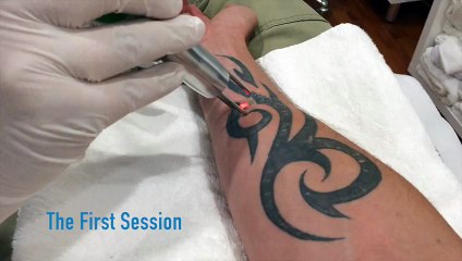 Removing a Tribal Tattoo: Part 2