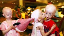 Awarness For Hutchinson-Gilford Progeria Syndrome  { HGPS }