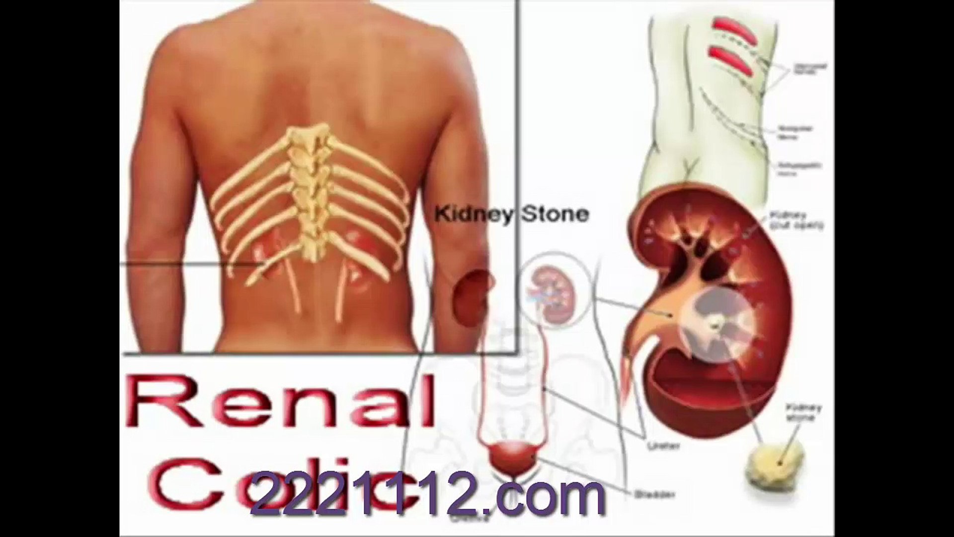 ⁣RENAL STONE  -  اردو