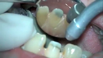 Tooth preparation for All-ceramic crown