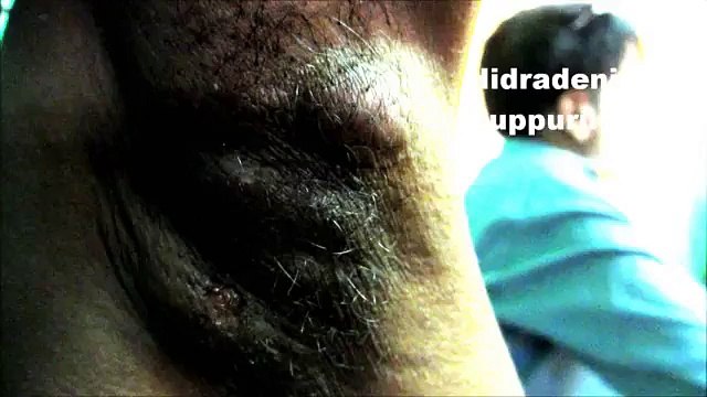 This disease is usually seen in axilla, groins, buttocks, under breast area, in the region where there is high density of apocrine glands, characterised by recurrent multiple abscess, fibrosis is also there with sinus formation, remains for many years, co