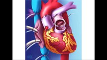 Aortic Valve Replacement Surgery Video