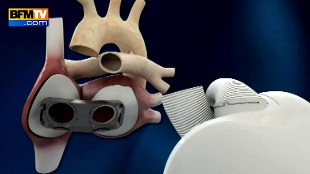 Cœur artificiel: un troisième patient greffé
