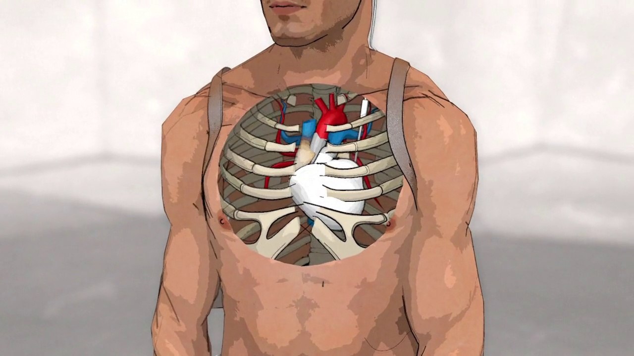 Le coeur artificiel