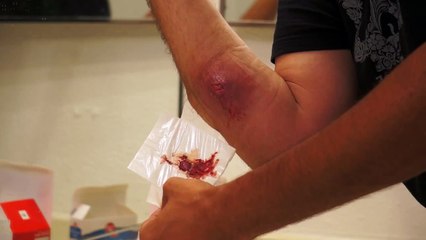 Removing gauze from spider bite