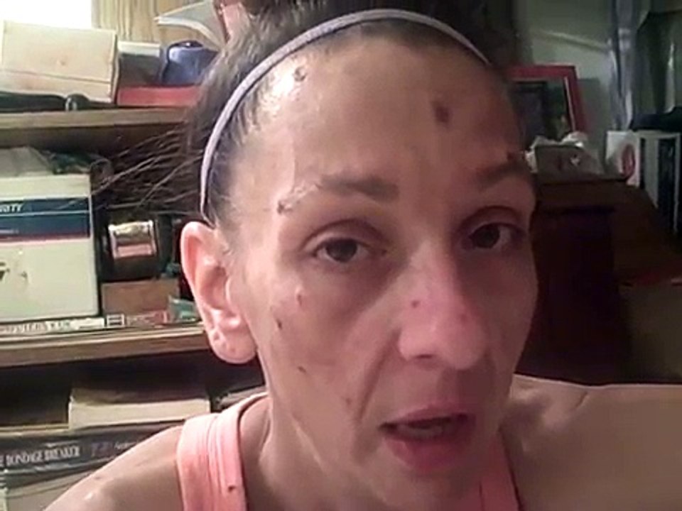 Face of Morgellons Disease - Getting the parasites to leave your skin within minutes!