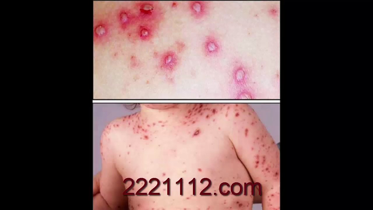 CHICKEN POX -  اردو