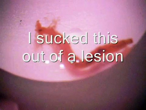 Morgellons Worm found in lesion Video Capture w Celestron Handheld Microscope