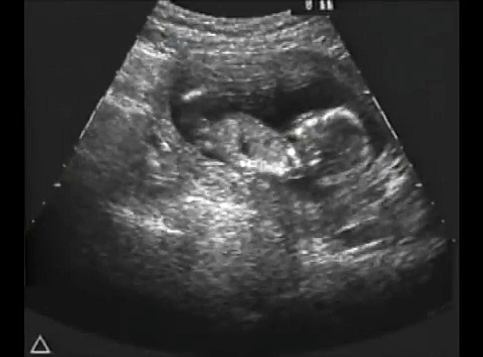 Ultrasound Fetal Response To Alcohol Fetal Alcohol Syndrome